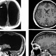 Is the Brain Really Necessary? The Answer Seems to be a No-Brainer
